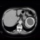 Cyst of a spleen, splenic cyst, calcified: CT - Computed tomography